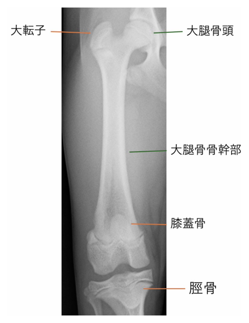 太ももの骨・レントゲン写真による図説