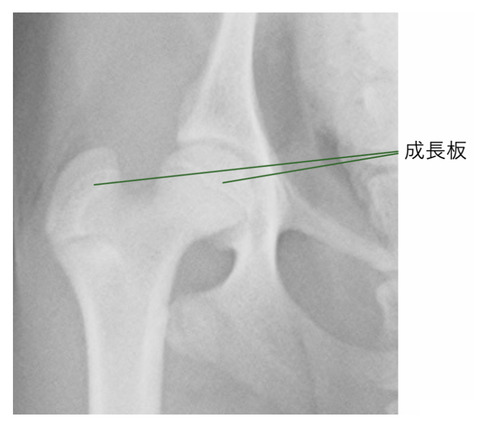 骨が成長する場所「成長板」を指し示すレントゲン写真