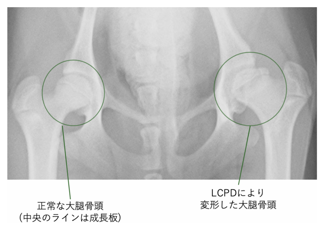 大腿骨頭の正常な形と、LCPDによる変形時の対比を示すレントゲン写真