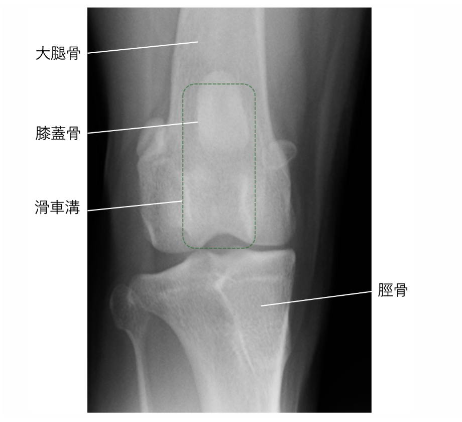 膝蓋骨を示すレントゲン写真