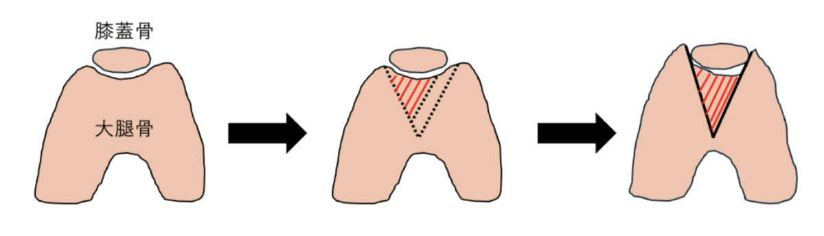 ウェッジ法と呼ばれるV字型に溝を深くする手技・イラストによる解説