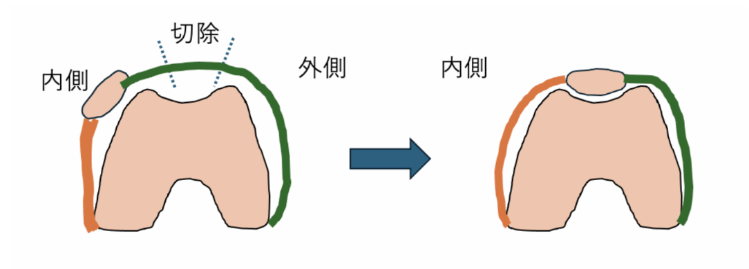 外側関節包縫縮・イラストによる解説