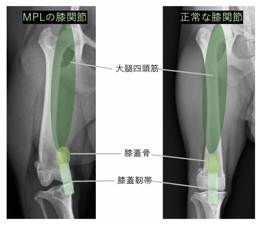 レントゲン写真を用いた説明図、術前のMPLと正常な膝関節を比較している。