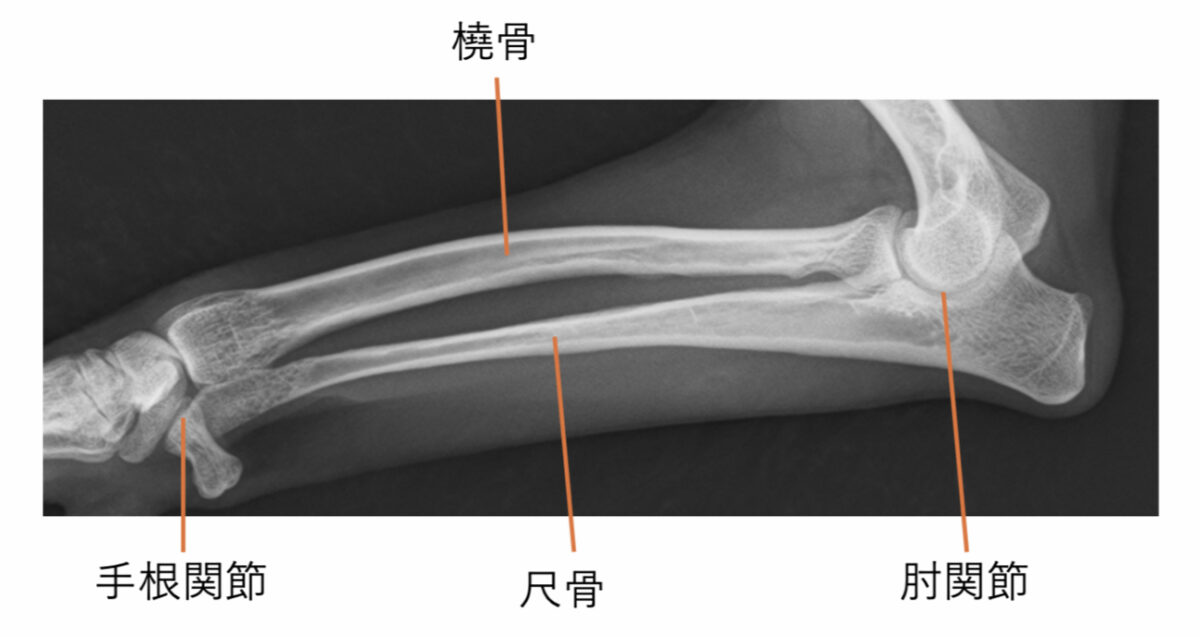 橈尺骨のレントゲン写真